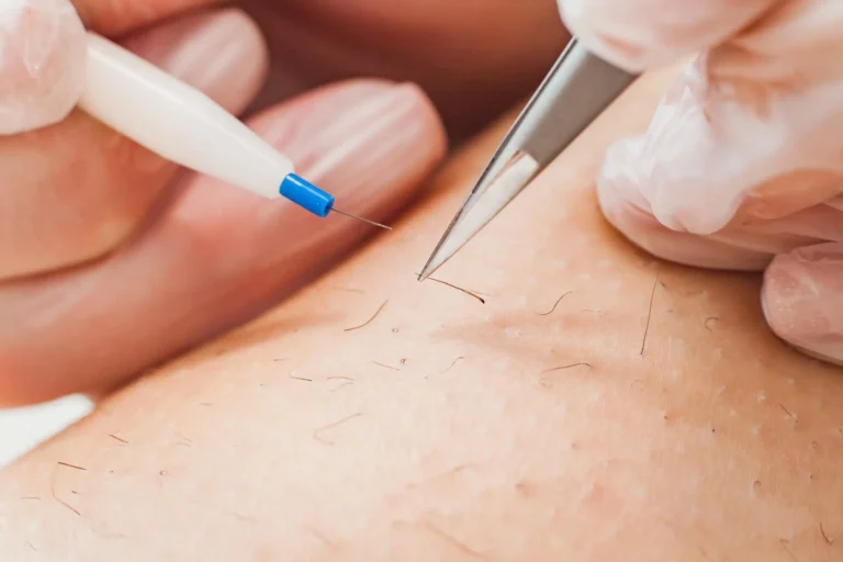Electrolysis-Hair-Removal-1-scaled